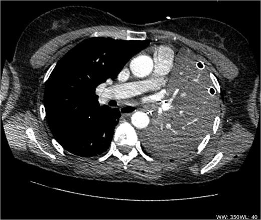 CT scan shows acute angulation of left lung hilum with complete obstruction of left lower lobe bronchus.