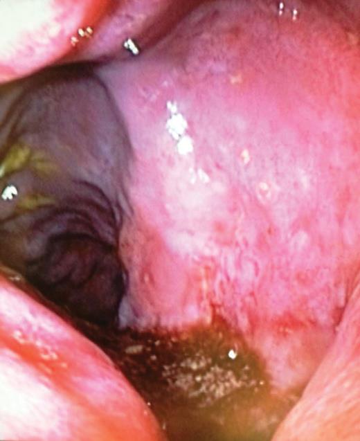 Pre-ethanol rectal venous malformations.