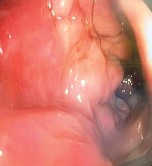 Six-month post-ethanol rectal venous malformations.