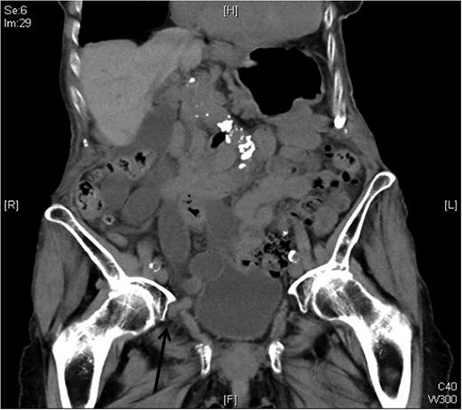 Abdominal CT scan showing the right-sided obturator hernia.