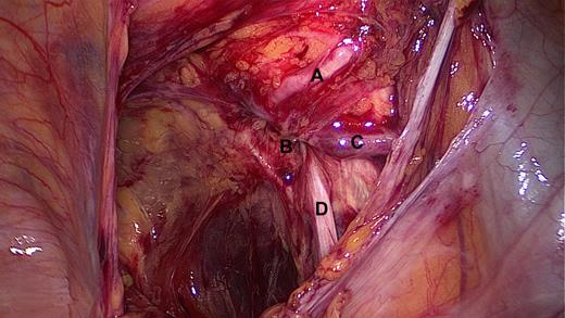 Intra-operative view after opening the peritoneum, showing the corona mortis (A) just above the obturator hernia orifice (B), the obturator vein with underneath the obturator artery (C) and the obturator nerve (D).