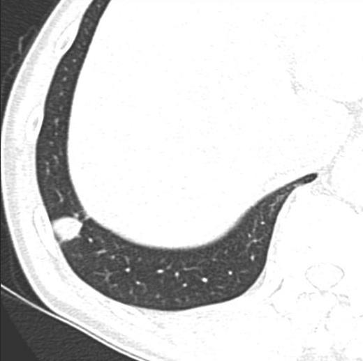 Pre-operative chest CT scan demonstrated the mass measuring 18 × 15 mm with spiculation at the periphery of S9 of the right lower lobe.