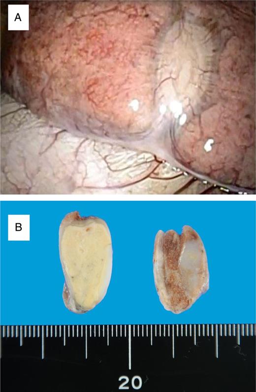 (A) Intra-operative thoracoscopy showed the white tumor with pleural indentation. (B) Macroscopic examination revealed white and solid tumor.