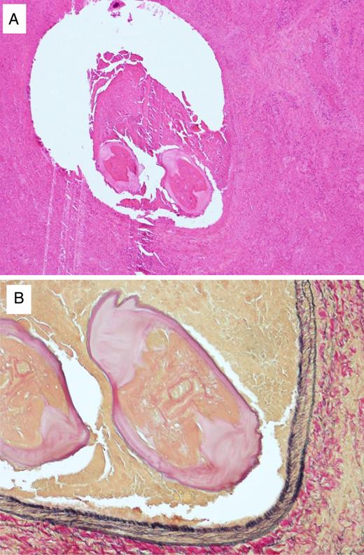(A) Histopathological findings of the pulmonary nodule. Two transverse sections of an immature worm were seen in the peripheral pulmonary with fibrous tissue, necrotic tissue, and granulation (hematoxylin and eosin staining, ×6). (B) The transverse section in the peripheral pulmonary revealed layers of cuticle, internal longitudinal cuticular ridges and lateral chords, being identified as Dirofilaria immitis (Elastica van Gieson stain, ×20).