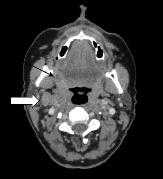 CT showing a primary tumour in the right glossotonsillar sulcus (black arrow) and lymphadenopathy (white arrow).