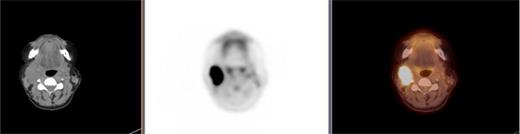 PET scan showing metastatic disease in the right level 2A lymph nodes.