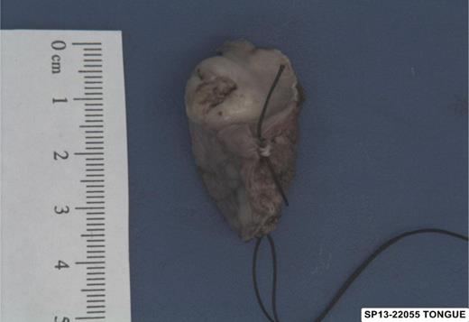 Macroscopic specimen of the primary tumour on the posterior aspect of the right side of the tongue.
