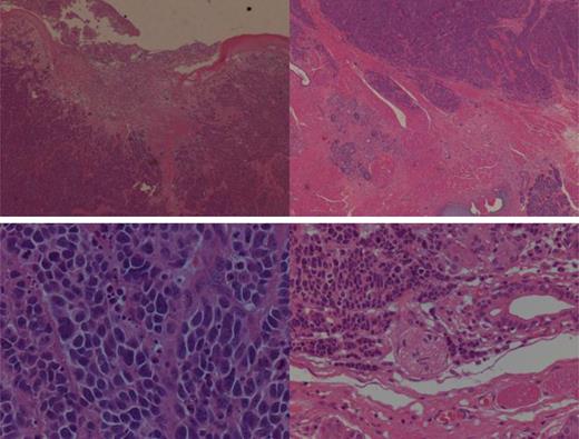 (Top left) Section through superior aspect, illustrating surface ulceration and normal adjacent squamous cells. (Top right) Low-power view of poorly differentiated small cell carcinoma. (Bottom left) High-power view of carcinoma, illustrating hyperchromatic nuclei with variable cytoplasm and apoptosis. (Bottom right) High-power view of carcinoma illustrating perineural invasion.