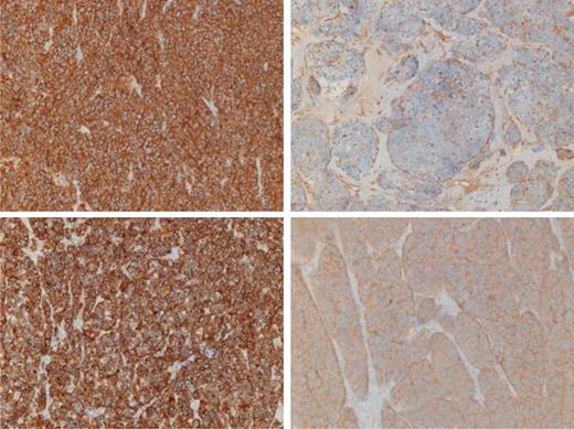 (Top left) Histopathology demonstrating positive CD 56, (top right) chromogranin, (bottom left) cam 5.2 and (bottom right) synaptophysin.