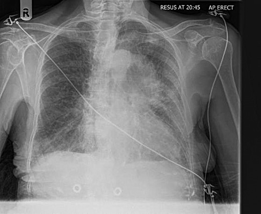 Chest radiograph showing a large mediastinal opacity.