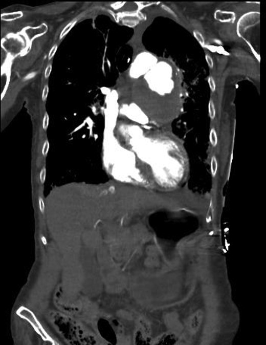 CT chest showing a mediastinal haematoma with active contrast extravasation.