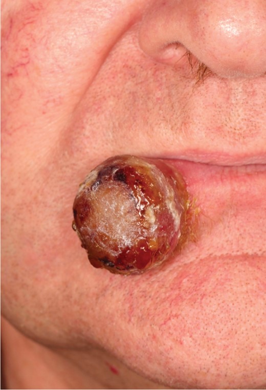 Pre-operative—rapidly growing tumour in the lower right lip.