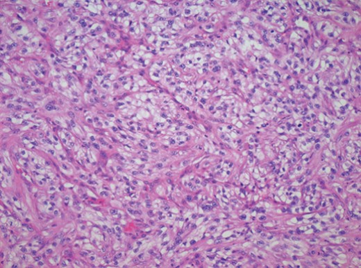 Photomicrograph of a specimen from the lower lip demonstrating the presence of RCC cells.