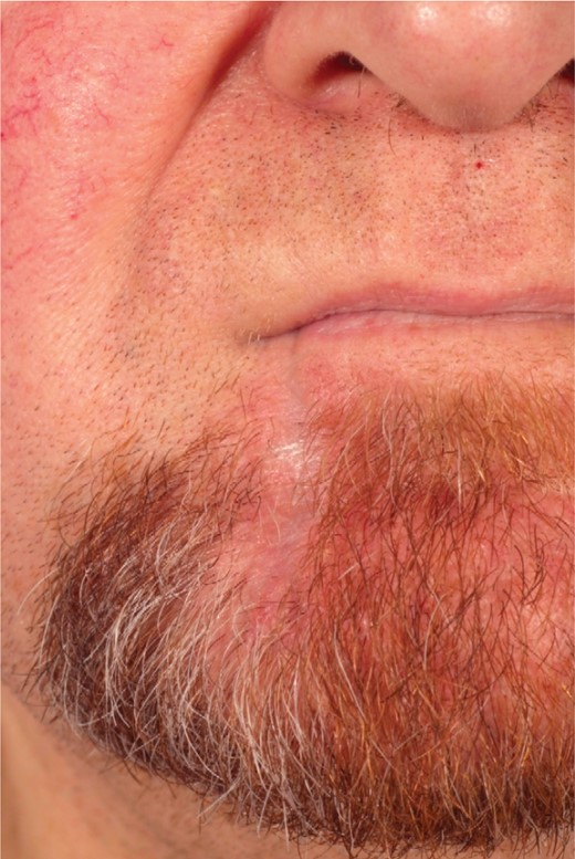 Post-operative—following resection and repair of the lower lip.