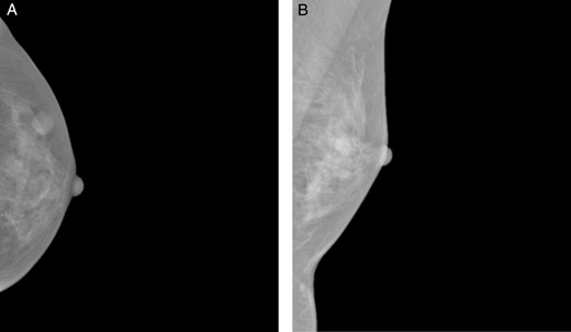 Craniocaudal (A) and mediolateral oblique (B) mammographic views demonstrating a well-circumscribed opacity in the central outer quadrant of the left breast.