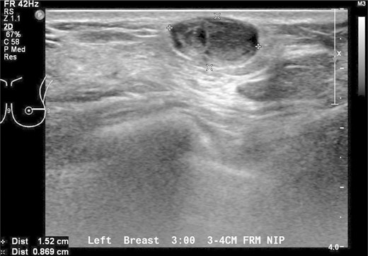 Sonographic views of an ovoid well-marginated nodule containing some cystic clefts. This lesion was initially thought to represent a phyllodes tumour.