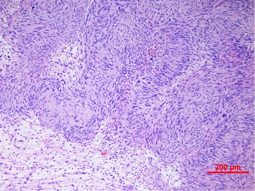 Spindle cell tumour with palisaded arrangement of nuclei, typical of schwannoma. Cellular (Antoni A) areas alternate with looser myxoid (Antoni B) areas.