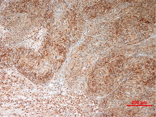 Immunohistochemistry showing tumour cells staining strongly and diffusely for S-100 protein.