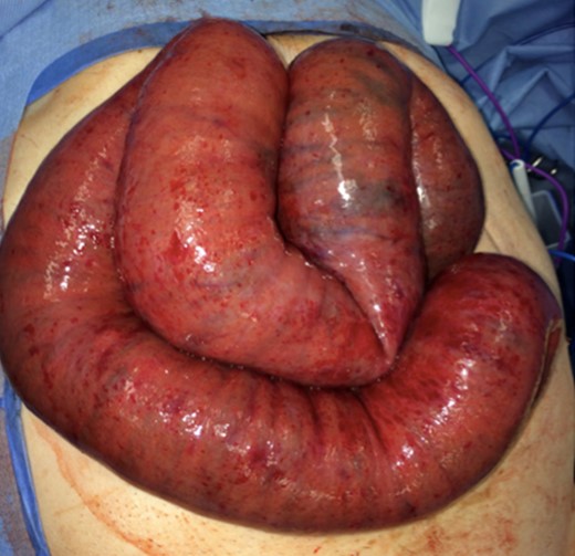 Intraoperative findings of massively distended small bowel loops with hemorrhagic enteritis.