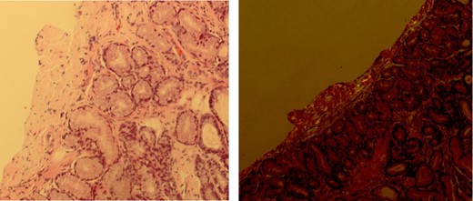 H&E and Congo Red stains showing amyloid deposition in the muscularis propria of the stomach.