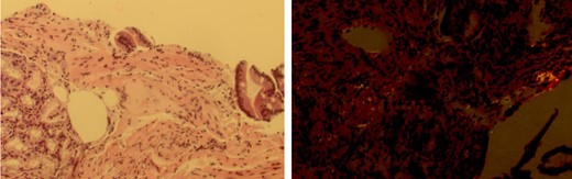 H&E and Congo Red stains showing amyloid deposition in the muscularis propria of the duodenum.