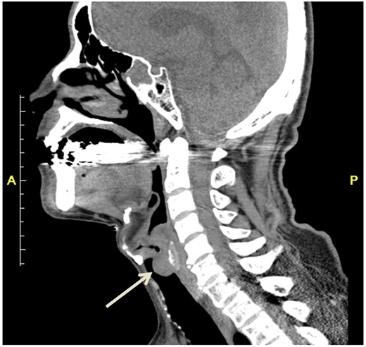 Computed tomography revealed a mass arising from the posterior wall of the trachea (arrow).