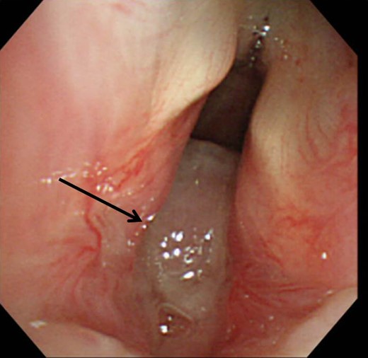 Bronchoscopy revealed a white subglottic tumor occupying 80% of the tracheal diameter (arrow).