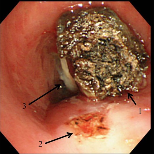 The intraoperative findings: the tumor (arrow 1) was resected by the abrasion of its pedicle, which arose from the tracheal membranous wall (arrow 2). The tracheostomy tube (arrow 3) prevented the tumor from falling into the distal airway.