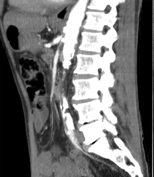 CT angiography—heavy calcification through abdominal aorta and severe stenosis of coeliac axis, renal arteries, SMA and IMA.