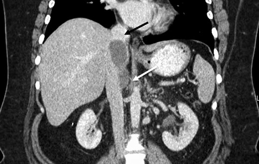 Preoperative CT identifying a smooth, well-circumscribed mass within the IVC arising superior to the right renal vein long (white arrow) and terminating just prior to right hepatic take-off (black arrow).