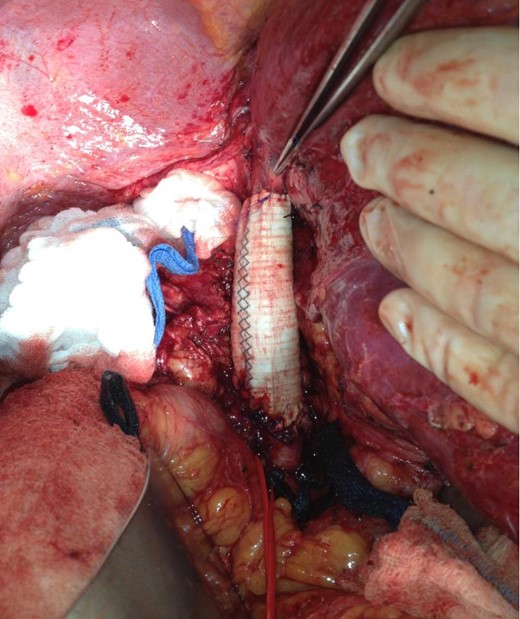 Extensively mobilized liver allows excellent view of the completed IVC reconstruction with Dacron interposition graft. Red vascular loop surrounds the right renal vein and forceps indicate take-off of the right hepatic vein.