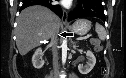 12-month postoperative CT showing stable IVC thickening (white arrow) after segmental resection of the IVC with tube graft reconstruction (black arrow).