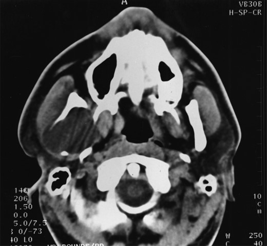 A well-demarcated lesion extending out into the soft tissues from the ramus of the mandible.