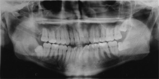 A nasopharyngeal tube in position.