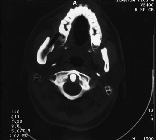 Demonstrates bony infill with the nasopharyngeal tube in place.