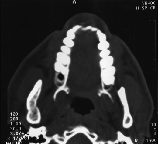 CT scan showing good bony infill.