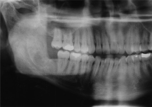 OPT showing good bony infill.
