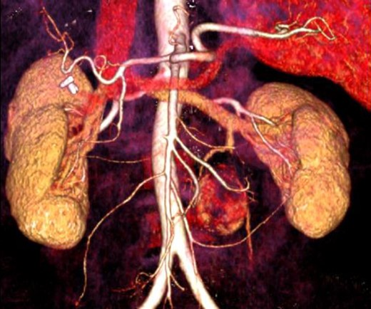CT angiography with a 3D reconstruction.