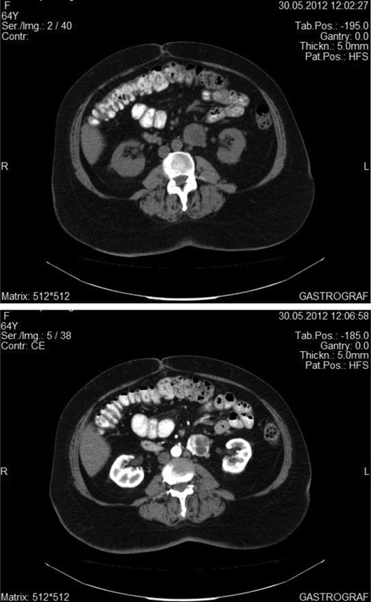 Abdominal CT showing the enhancement of the tumor after intravenous administration of an iodine material.