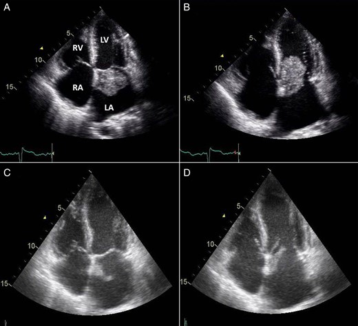 TTE 4-chamber view during systole (A) and diastole (B) showing a large LAM attached to the interatrial septum and obstructing diastolic filling of the left ventricle and follow-up four-chamber view during systole (C) and diastole (D) showing a marked reduction in the size of the LAM (LA, left atrium; LV, left ventricle; RA, right atrium; RV, right ventricle).