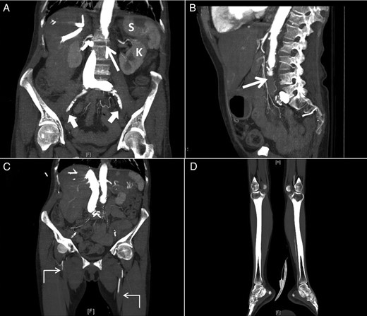 Sagittal (A) and coronal (B) computed tomographic angiogram images of the abdomen and pelvis and coronal images (C and D) of both lower extremities showing occlusion of the distal infra-renal abdominal aorta (thin arrow) and iliacs (thick arrows) and superficial femoral arteries with weak runoff on the left and no runoff on the right side (angled arrows) with multifocal infarcts of the spleen (S) and left kidney (K).