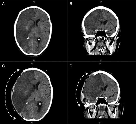 Axial (A and C) and coronal (B and D) CT images of the brain showing a large infarct in the area of the right middle cerebral artery before (A and B) and after (C and D) right hemicranial decompression with transcranial herniation of the right cerebral hemisphere (interrupted curved arrows).
