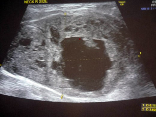 USG of the neck: hyperechoic cystic lesion abutting the postero-lateral aspect of the right lobe of thyroid.