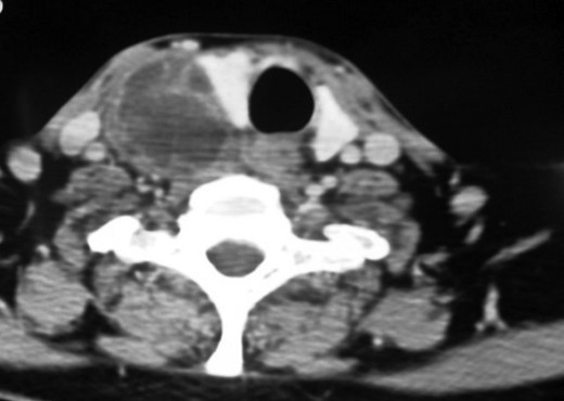 Contrast enhanced CT neck (axial section). Heterogeneously enhancing lesion with multiple cystic areas within abutting the postero-lateral aspect of the right lobe of thyroid, pushing it anteriorly and medially.
