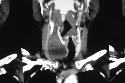Contrast enhanced CT neck (coronal section). Coronal section showing good plane of delineation between the lesion and carotid sheath, along with mass effect on the thyroid gland and the right common carotid.