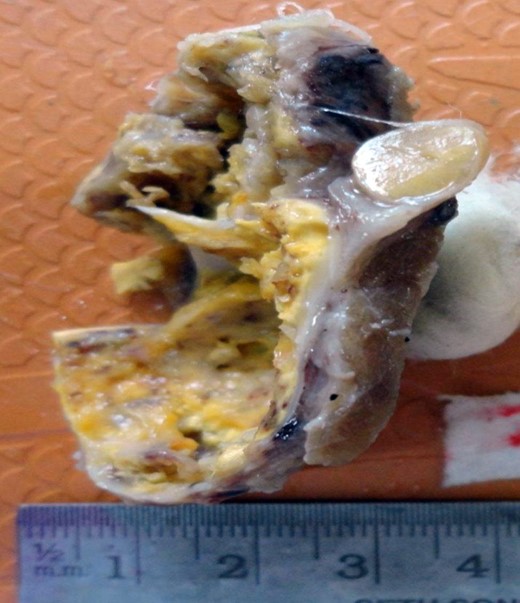 Cross section of hemithyroidectomy specimen: a well-circumscribed cystic lesion with yellowish colour of the inner cyst wall; a rim of normal thyroid is seen at the periphery.
