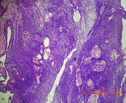 Microscopic section (H&E slide, 40×) of well-encapsulated lesion with hyper- (Antoni A) and hypocellular (Antoni B) areas. Multiple cystic areas are also seen.