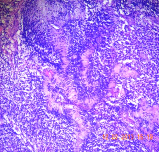 Microscopic section (H&E slide, 40×) of Verocay bodies within Antoni A pattern.