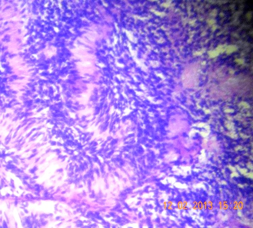 Microscopic section (H&E slide, 100×) of magnified view of a region in Fig. 6 showing Verocay bodies.