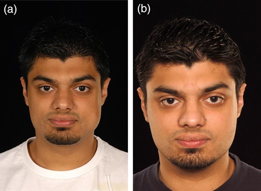Case 1: (a) pre-treatment and (b) post-treatment.